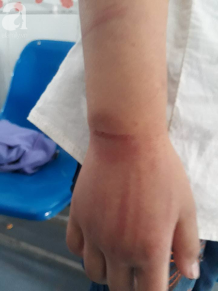 Vụ bé gái 10 tuổi bị bố đánh bầm tím toàn thân: Người mẹ nhiều lần bị chồng đánh đập - Ảnh 4. Vụ bé gái 10 tuổi bị bố đánh bầm tím toàn thân: Người mẹ nhiều lần bị chồng đánh đập - Ảnh 4.