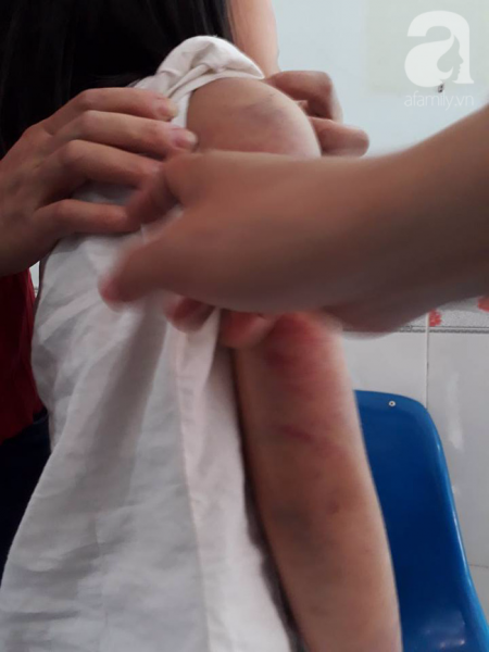 Vụ bé gái 10 tuổi bị bố đánh bầm tím toàn thân: Người mẹ nhiều lần bị chồng đánh đập - Ảnh 1. Vụ bé gái 10 tuổi bị bố đánh bầm tím toàn thân: Người mẹ nhiều lần bị chồng đánh đập - Ảnh 1.