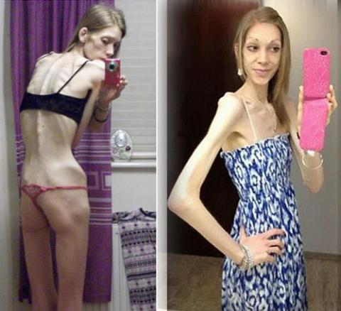 tu mot bo xuong kho di dong sap chet, co gai da lot xac ngoan muc sau 18 thang - 1