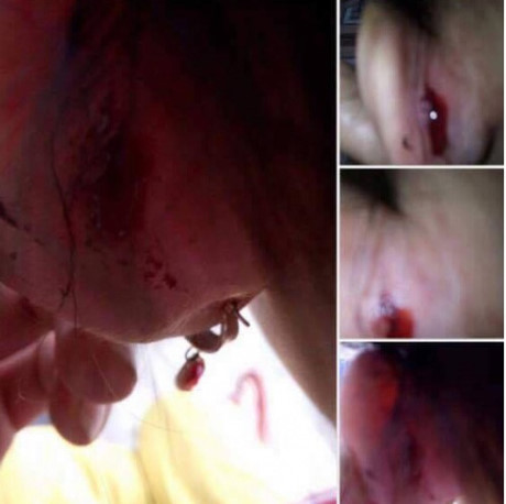 Cô giáo mầm non quệt tay làm chảy máu tai trẻ 4 tuổi - Ảnh 1.