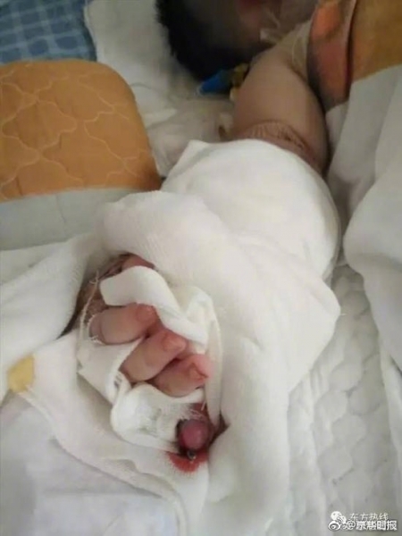 Bé sơ sinh bị bác sĩ cắt mất ngón tay khi đến viện thay băng vết bỏng - Ảnh 1.