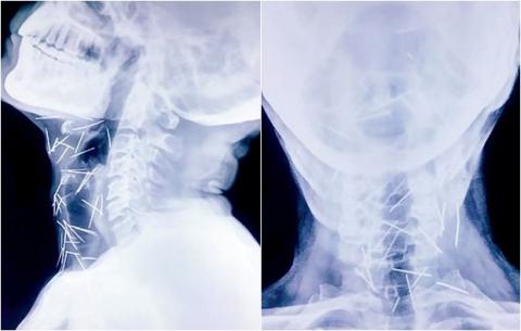 Tim thay 75 cay kim trong co the cua benh nhan