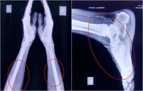 Tim thay 75 cay kim trong co the cua benh nhan