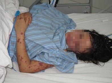 HN: Cô gái 18 tuổi bị cách ly khẩn cấp vì viêm não mô cầu - 1