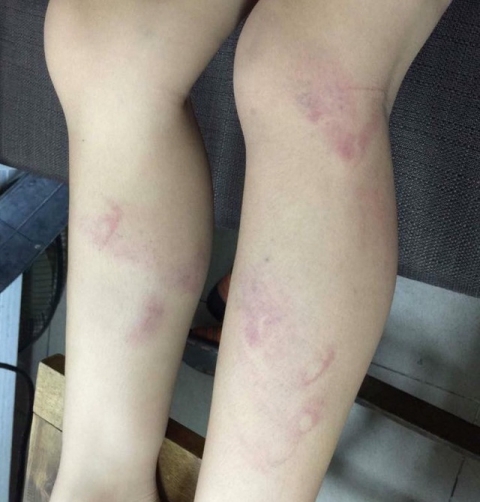 Vết thâm tím ở chân của học sinh bị cho là giáo viên trường tiểu học Nguyễn Tri Phương đánh. (Facebook phụ huynh N.T.H).