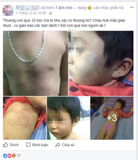 Sự thật vụ bé gái 4 tuổi bầm tím khắp cơ thể khi đi học - 1