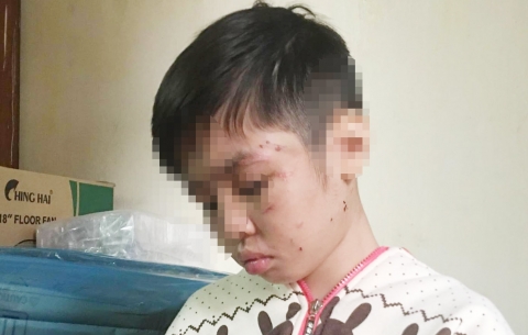 Bé trai bị đánh rạn xương sườn: Mẹ kế khai lý do hành hạ con chồng - 1