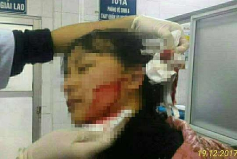 Nữ sinh 16 tuổi bị rạch mặt phải khâu gần 40 mũi - 1