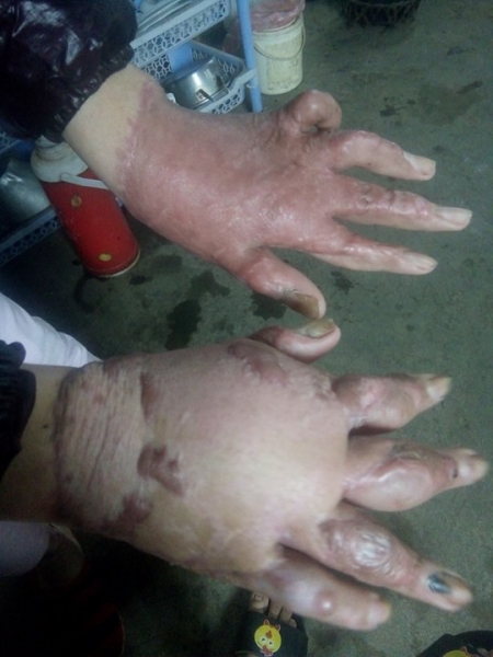
Bàn tay chị Trang đã được phẫu thuật tay nhưng vẫn khó khăn trong việc cầm, nắm (ảnh nhân vật cung cấp)
