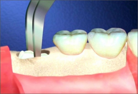 Sức khỏe - Từ vụ chết người vì nhổ răng: Những nguy cơ có thể xảy ra khi nhổ răng số 8