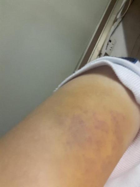 tp.hcm: vo bi bo nhi cua chong danh ghen nguoc, dung tuyp sat danh dap da man - 2