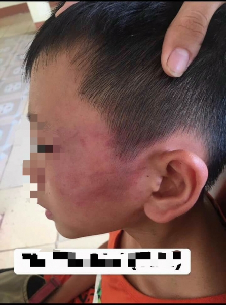 Bé trai 12 tuổi nghi bị mẹ kế đánh nhập viện ở Nghệ An: Mẹ kế là giáo viên, do thằng bé ăn nói hỗn láo nên mới dạy - Ảnh 2.