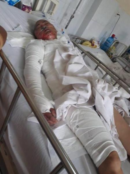 
Bị chồng tẩm xăng thiêu sống, tính mạng chị H. như ngàn cân treo sợi tóc. Ảnh: HL
