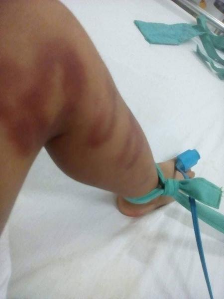 Bé trai 4 tuổi nguy kịch do người tình của mẹ bạo hành dã man Bé trai 4 tuổi nguy kịch do người tình của mẹ bạo hành dã man