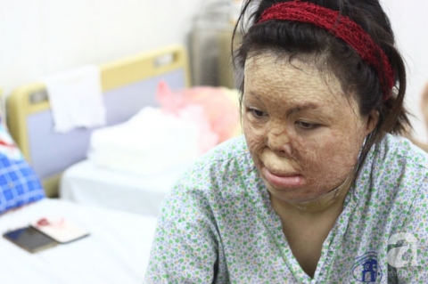 Sau 1 năm và hàng chục cuộc phẫu thuật, người vợ Hà Nội bị chồng thiêu hôm mùng 2 Tết, chỉ có 1% cơ hội sống sót đã hồi sinh