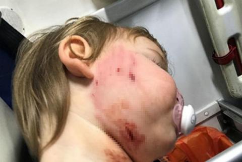 be gai 18 thang tuoi bi cho can rach mat, chu cho tho o dung nhin khong them xin loi - 2