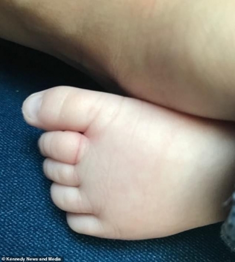Bé sơ sinh suýt phải cắt bỏ 4 ngón chân vì 1 sợi tóc của mẹ - 4