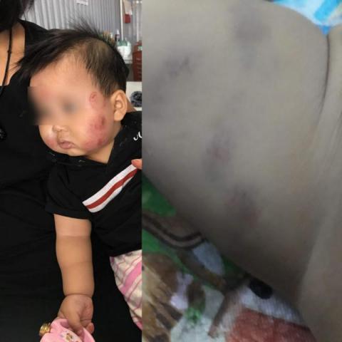 thong tin bat ngo vu be trai 10 thang tim dui, mat nhieu vet thuong khi di hoc mam non - 2