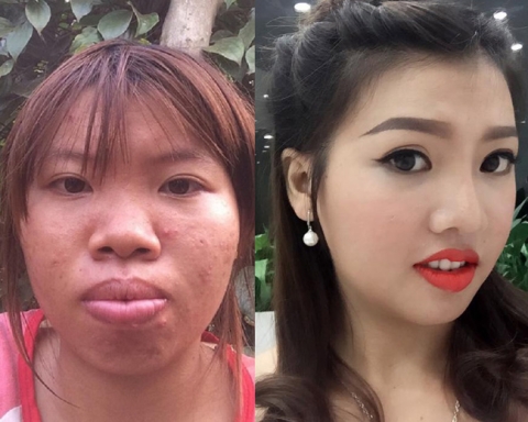 8 ca thẩm mỹ của chị em Việt gây bão dư luận vì biến gái xấu thành tiên-1