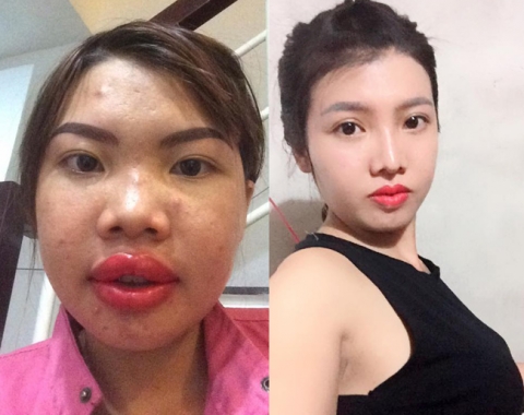 8 ca thẩm mỹ của chị em Việt gây bão dư luận vì biến gái xấu thành tiên-2