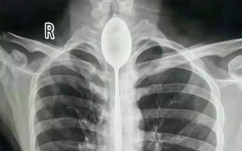 6 trường hợp y khoa kỳ lạ nhất 2018, hai người trong đó đã tử vong