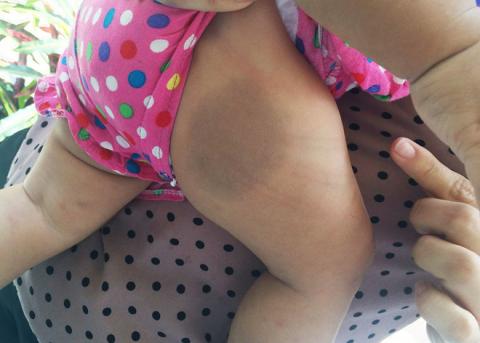 Bé gái 8 tháng tuổi nghi bị mẹ nuôi bạo hành, nhốt trong phòng trọ