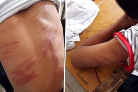 Người nam sinh L. chi chít những vết thương do đòn roi. Ảnh: Facebook.