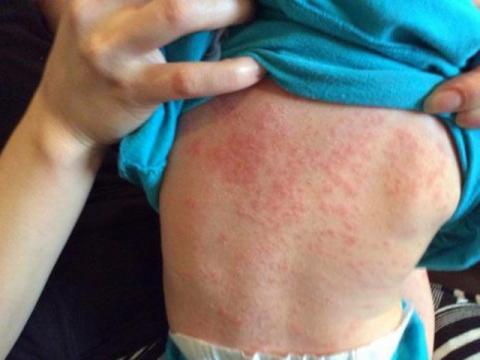 benh soi tan cong ca tre nho va nguoi lon trong mua he: nhung bieu hien can nhap vien ngay - 1