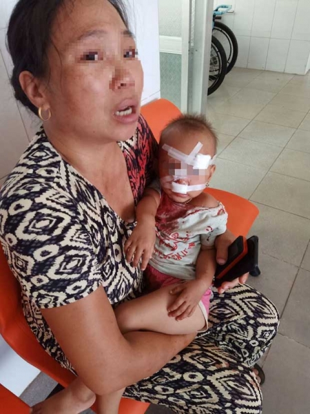 Mẹ bé gái bị cha ruột ném ly vào mặt, khâu 12 mũi: 'Lúc 13 tháng, con bé cũng bị ném vật cứng làm chấn thương sọ não'