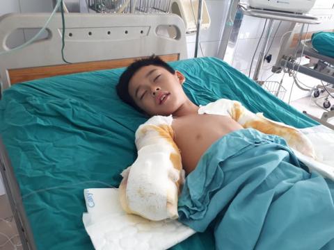 Mất đôi tay, cậu bé 12 tuổi bị điện giật chỉ mong giữ được đôi chân - 2