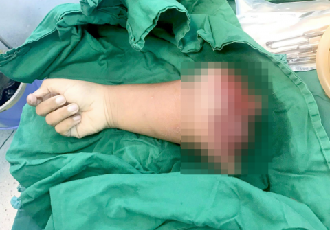 Kinh hoàng: Bé trai 8 tuổi tự chạy xe máy gặp tai nạn đứt lìa cánh tay