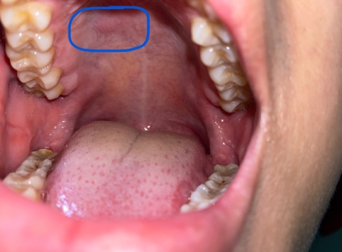 4 triệu chứng điển hình thường xuất hiện trong giai đoạn đầu của bệnh ung thư miệng - 3