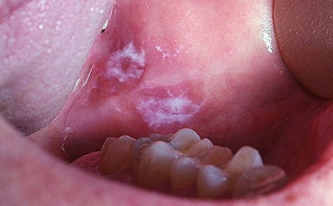 Thấy môi có hiện tượng này, đi khám ung thư miệng ngay kẻo hối hận