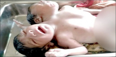 Không đi khám thai thường xuyên, cặp vợ chồng sửng sốt khi sinh ra đứa con có 2 đầu và 3 cánh tay - Ảnh 2.