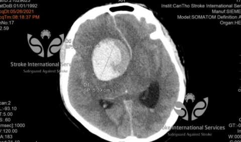 Túi phình mạch máu của bệnh nhân có kích thước lên tới 5cm.