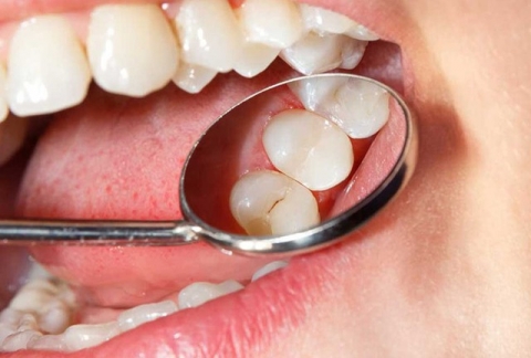 Điều gì xảy ra khi bạn không đánh răng vào ban đêm? - Ảnh 1.
