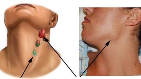 Tưởng ho do Covid-19, đi khám mới hay mắc ung thư giai đoạn 4: Làm thế nào để phân biệt? - Ảnh 2.