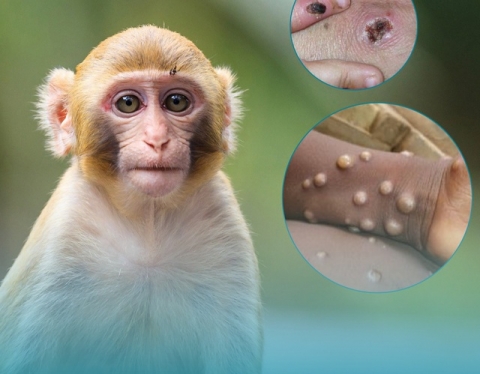 Bệnh đậu mùa khỉ ảnh hưởng tới thai kỳ thế nào? - Ảnh 1.