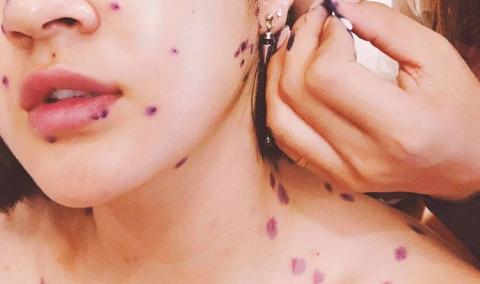 Đề phòng những biến chứng nguy hiểm của thủy đậu - Ảnh 2.