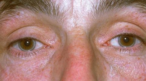 Bác sĩ Anh tiết lộ 4 dấu hiệu cảnh báo mỡ máu tăng vọt, nhận biết sớm có thể phòng ngừa đau tim, đột quỵ- Ảnh 3. Bác sĩ Anh tiết lộ 4 dấu hiệu cảnh báo mỡ máu tăng vọt, nhận biết sớm có thể phòng ngừa đau tim, đột quỵ- Ảnh 3.