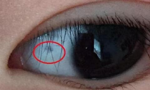 4-4-dau-hieu-ung-thu-ma-1.jpg 3