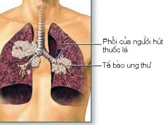 Những nguy cơ dẫn đến ung thư phổi