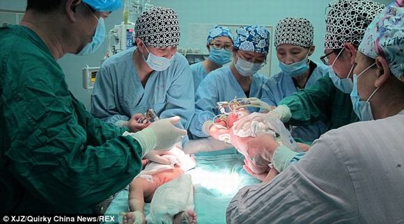 Song sinh dính liền nhau được phẫu thuật tách rời thành công ở Trung Quốc