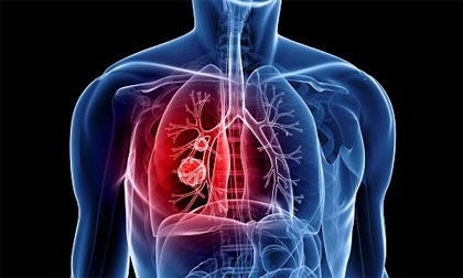 Thuốc mới trị bệnh ung thư phổi hiếm gặp