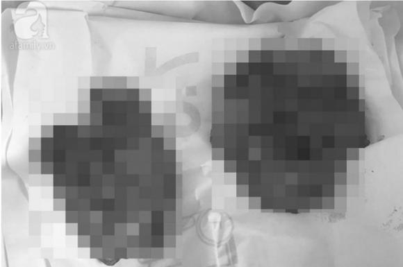 TP.HCM: Bơm silicon để ngực to như phụ nữ, nam thanh niên phải nhận cái kết đắng - Ảnh 4. TP.HCM: Bơm silicon để ngực to như phụ nữ, nam thanh niên phải nhận cái kết đắng - Ảnh 4.