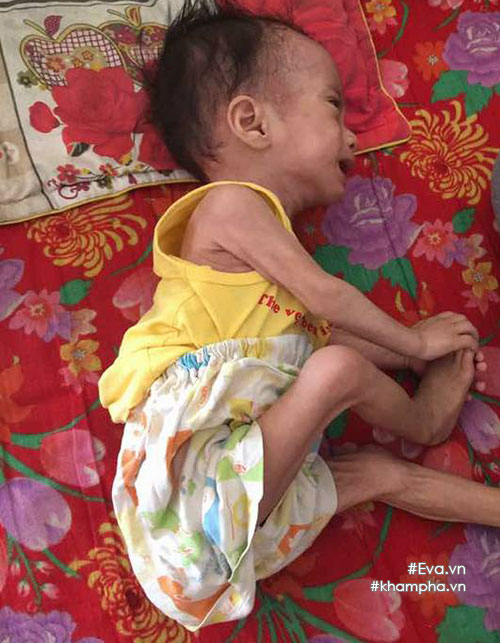 xot xa hinh anh em be sinh ra nang 4kg, sau mot nam chi con 3,4kg - 1