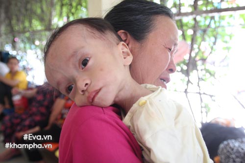 xot xa hinh anh em be sinh ra nang 4kg, sau mot nam chi con 3,4kg - 5