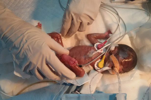 suc song ky dieu cua em be nho nhat the gioi, nang chua day 0,5kg khi chao doi - 2