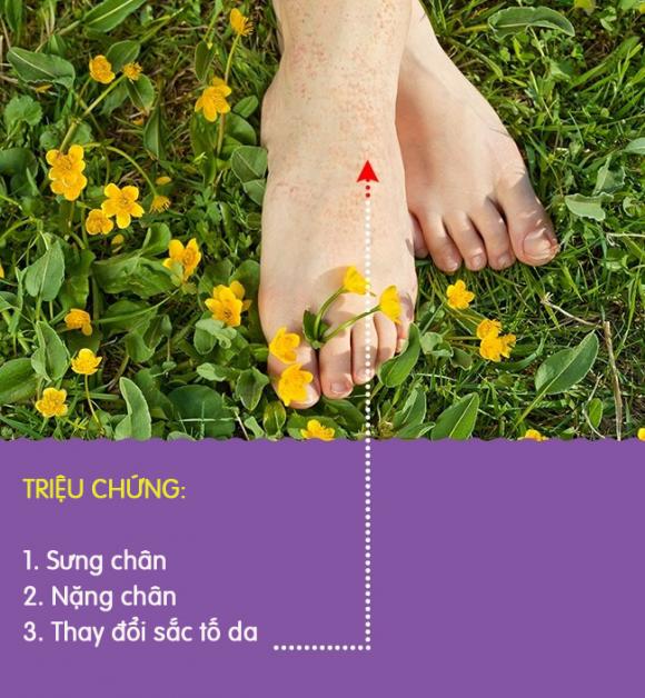 8 biểu hiện khác lạ ở chân là dấu hiệu cảnh báo có thể bạn đang gặp bệnh nghiêm trọng - Ảnh 3. 8 biểu hiện khác lạ ở chân là dấu hiệu cảnh báo có thể bạn đang gặp bệnh nghiêm trọng - Ảnh 3.