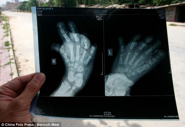 Bức ảnh X-quang chụp 2 bàn chân cuat Yu Yu cho thấy xương bàn chân của bé gái đã bị biến dạng và cong hướng ra ngoài. 
